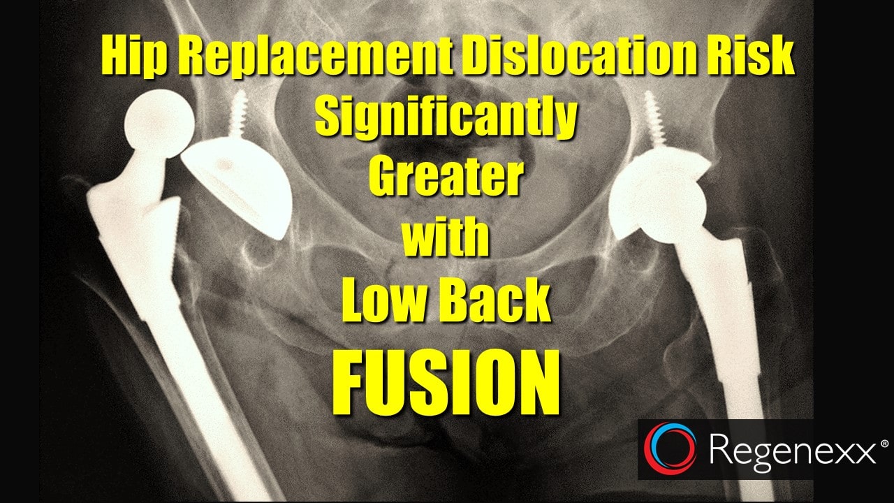 hip replacement after lumbar fusion