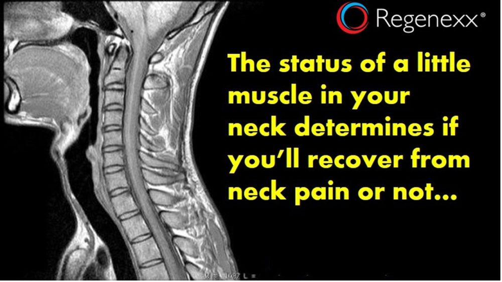 How to Recover from Neck Pain? A Little Muscle Holds the Key…