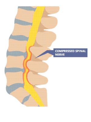 Medical illustration showing a portion of the spine and a compressed spinal nerve