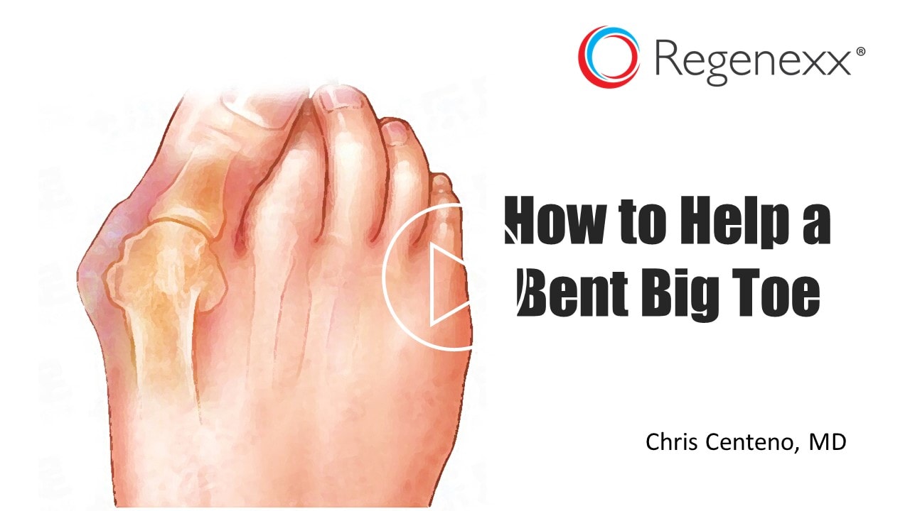 Big Toe Bent To The Side? Here's How to Help - Regenexx Blog