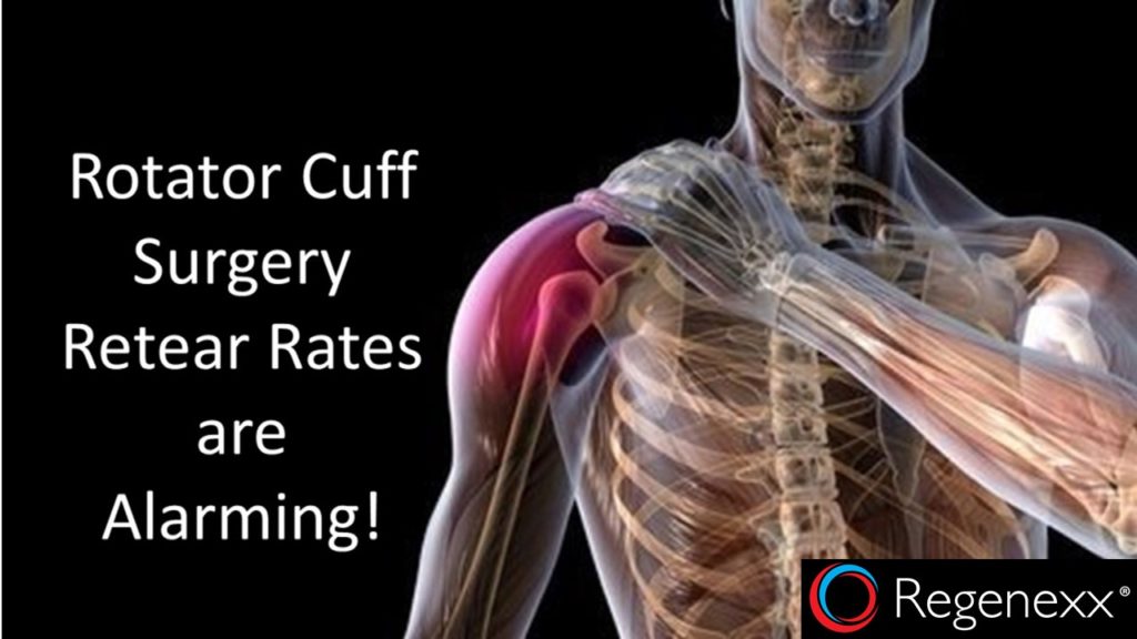 Rotator Cuff Surgery Retear Rates Are Alarming!