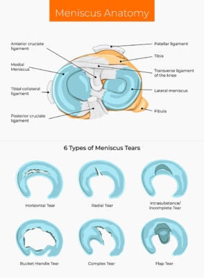 Medical illustration showing meniscus anatomy and six types of meniscus tears