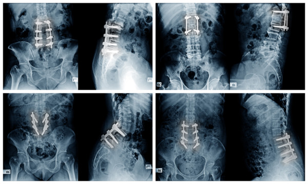 Multiple x-rays showing the results spinal fusion surgeries