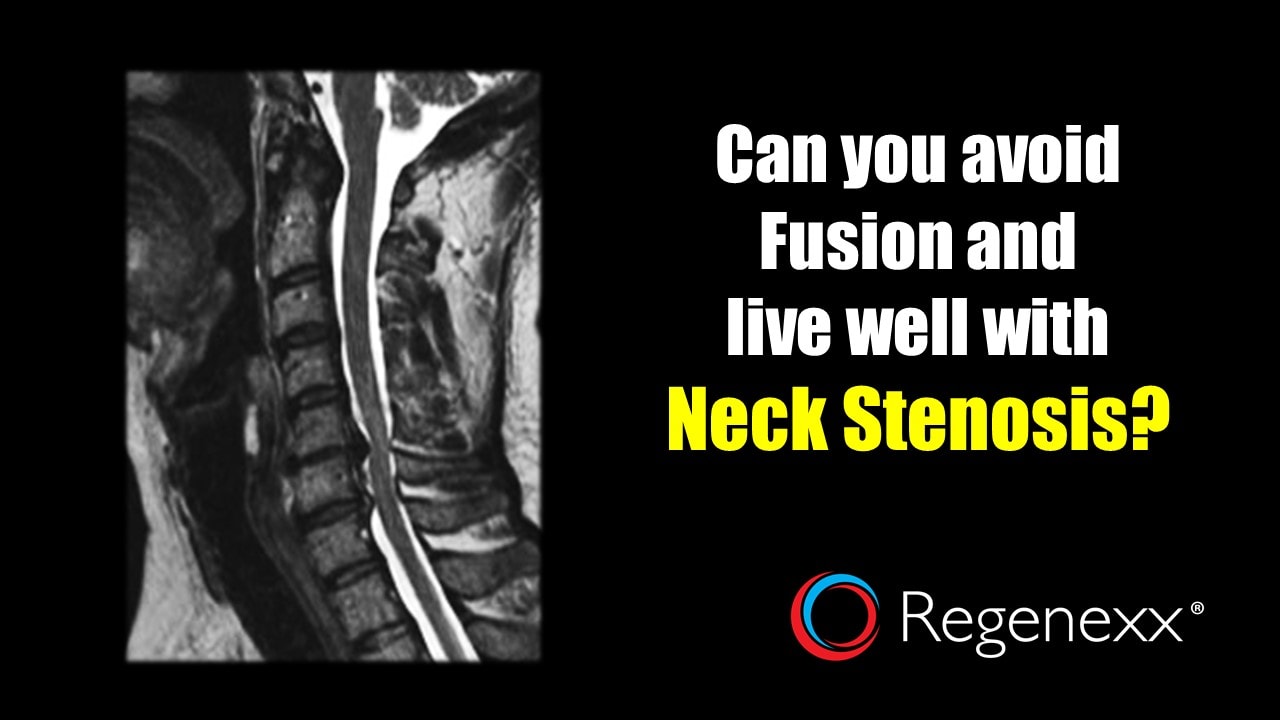 Living With Cervical Spinal Stenosis: My Story - Regenexx