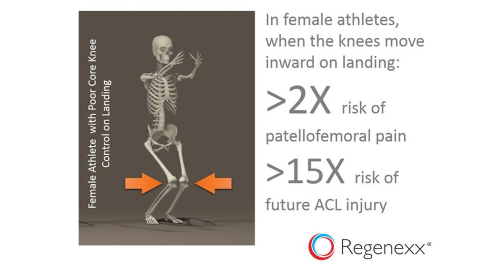 ACL Injury Causes: Girls Who Lack Knee Control are 15X More Likely to Injure Their Knee ACL Ligaments
