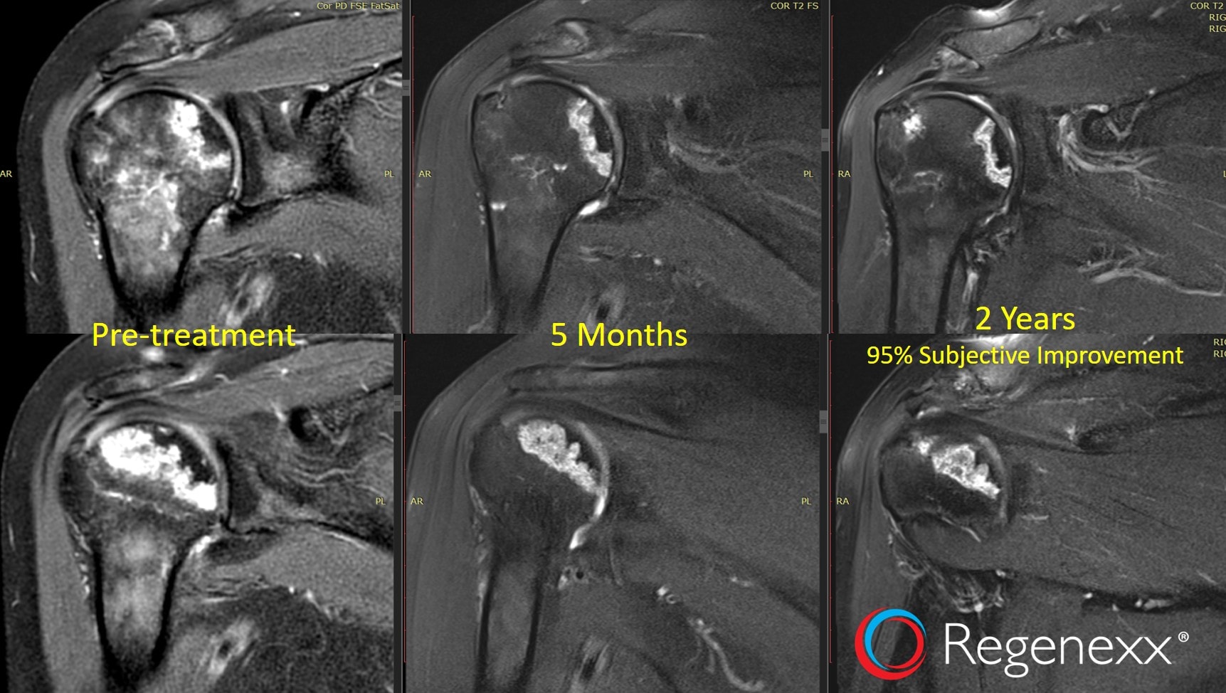 shoulder AVN treatment