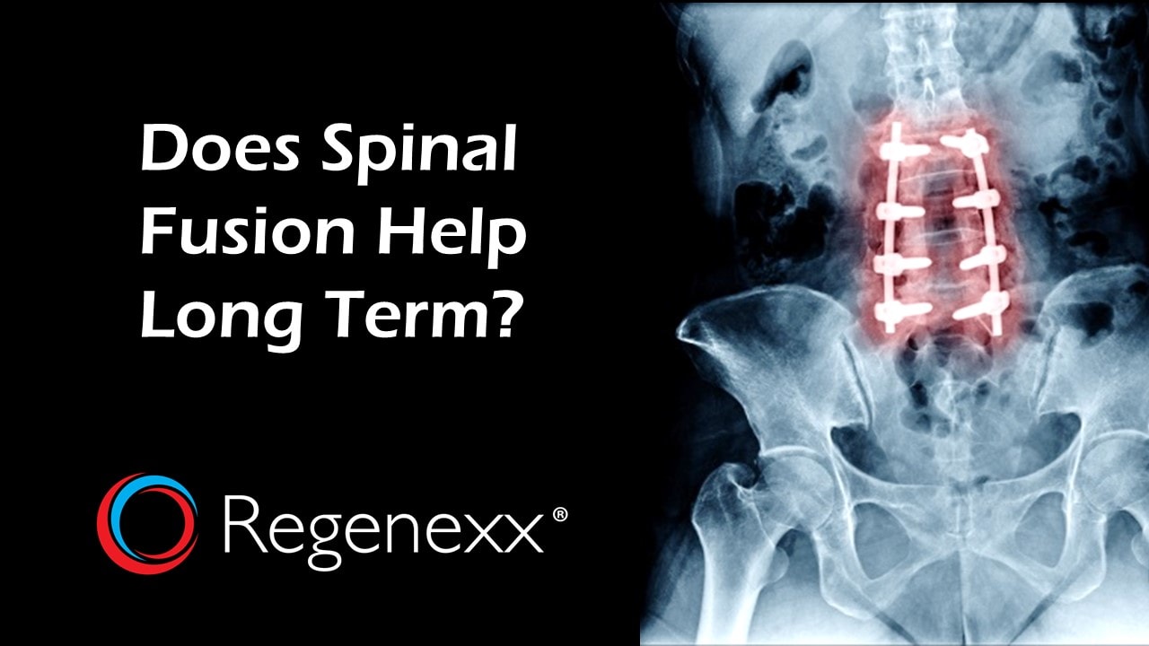 severe-leg-pain-after-spinal-fusion-causes-solutions