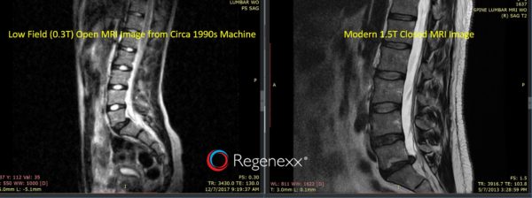 An MRI from the 1990s next to an MRI from 2017 to show the difference in quality 
