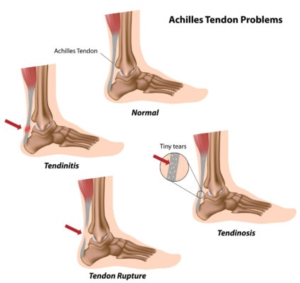 Medical illustration showing a healthy Achilles tendon and three examples of injuries to the Achilles tendon