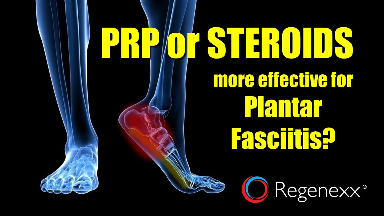 PRP Injections vs Steroids for Plantar Fasciitis Regenexx Blog