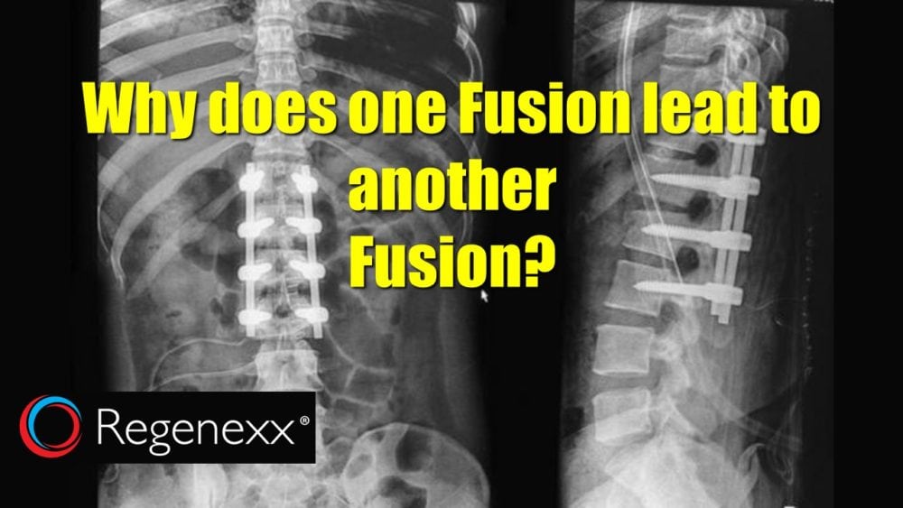 The Long-Term Side Effects of Spinal Fusion