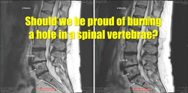 Two MRIs of the spinal cord showing holes in the vertebrae with the text: Should we be proud of burning a hole in a spinal vertebrae?