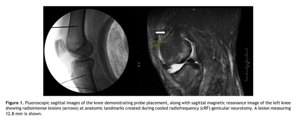 Knee Arthritis Nerve Treatment