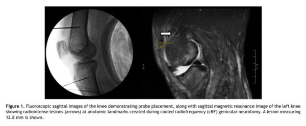 MRI of the knee showing probe placement and lesions created by radiofrequency
