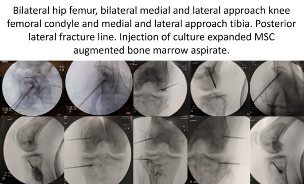 Image of cultured expanded msc injection for patient with hip avascular necrosis