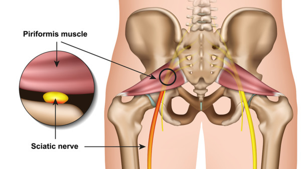 Medical illustration showing the pelvis and the relationship of the piriformis muscle and the sciatic nerve 