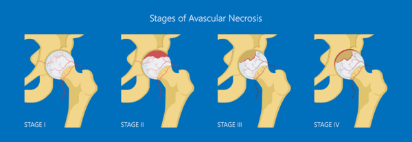 Medical illustration showing the stages of avascular necrosis