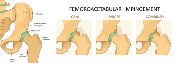 Medical illustration of the hip and three types of hip impingement