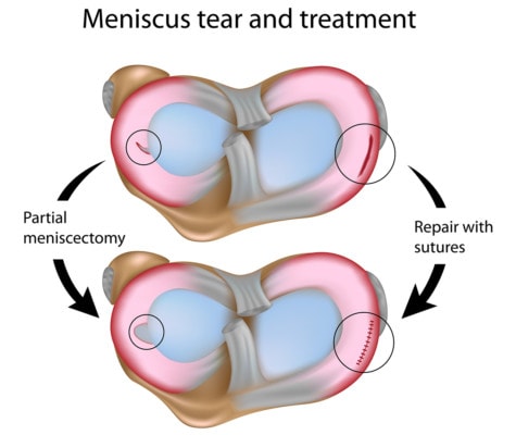 Medical illustration showing meniscus tears repaired with sutures and with a partial meniscectomy