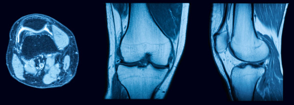 Magnetic resonance imaging (MRI) of right knee with three views