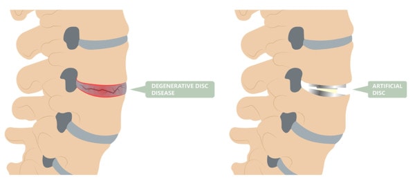 Medical illustration showing a spine with a degenerative disc and a spine with an artificial disc
