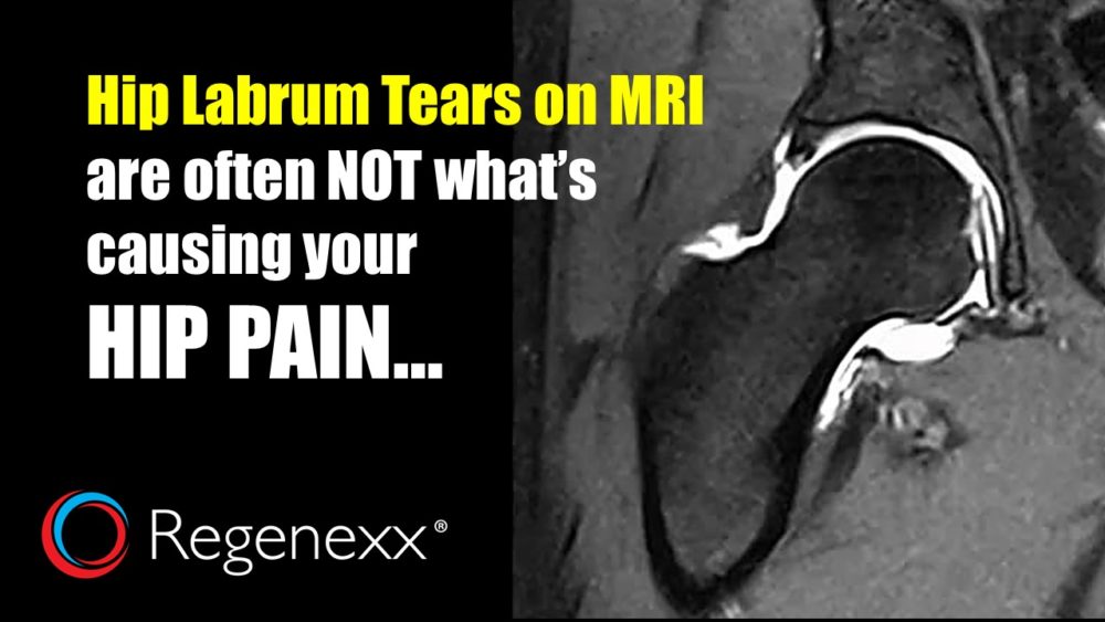 Labrum Tear on Your MRI? It May Not Be Related to Your Hip Pain