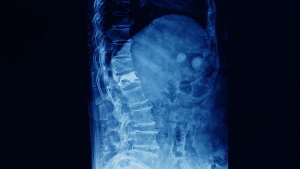 X-ray showing compression fracture of the spine treated with vertebroplasty
