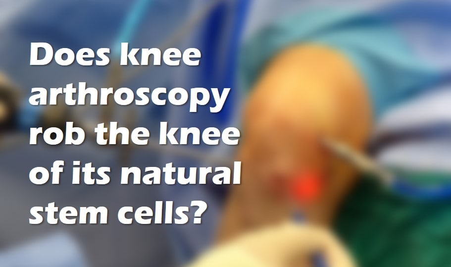 knee arthroscopy stem cells