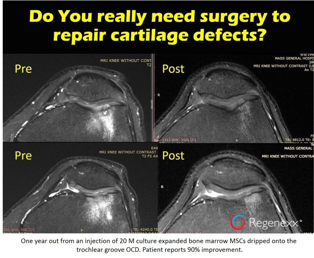knee cartilage surgery