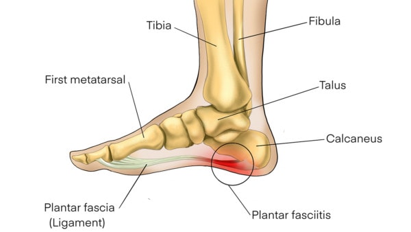 Medical illustration showing the anatomy of a foot affected by plantar fasciitis