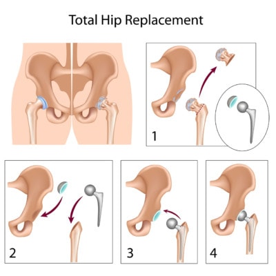 Medical illustration showing the steps of a total hip replacement