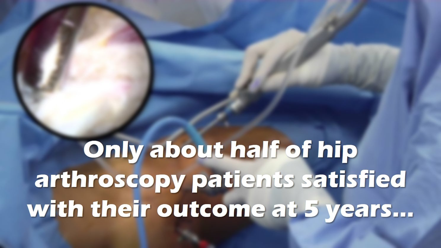 only about half of hip arthroscopy patients report long