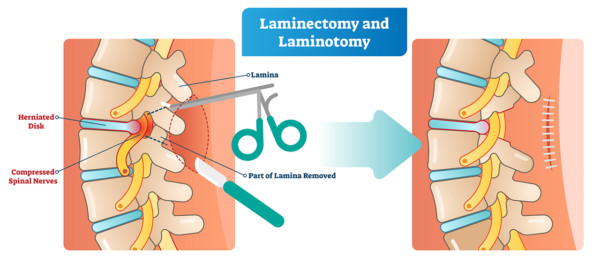Medical illustration showing examples of laminectomy and laminotomy surgeries on the spine