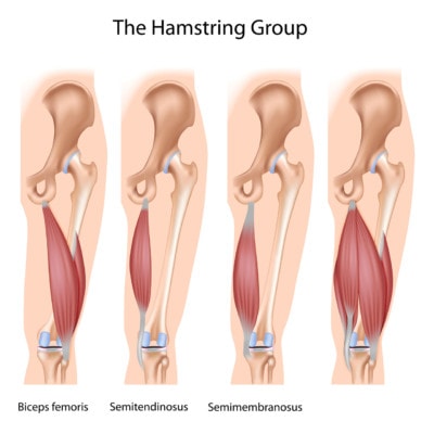 Medical illustration showing the muscles that make up the hamstring in isolation and together 