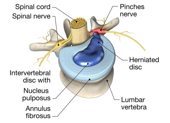 Medical illustration showing herniated disc or slipped disc