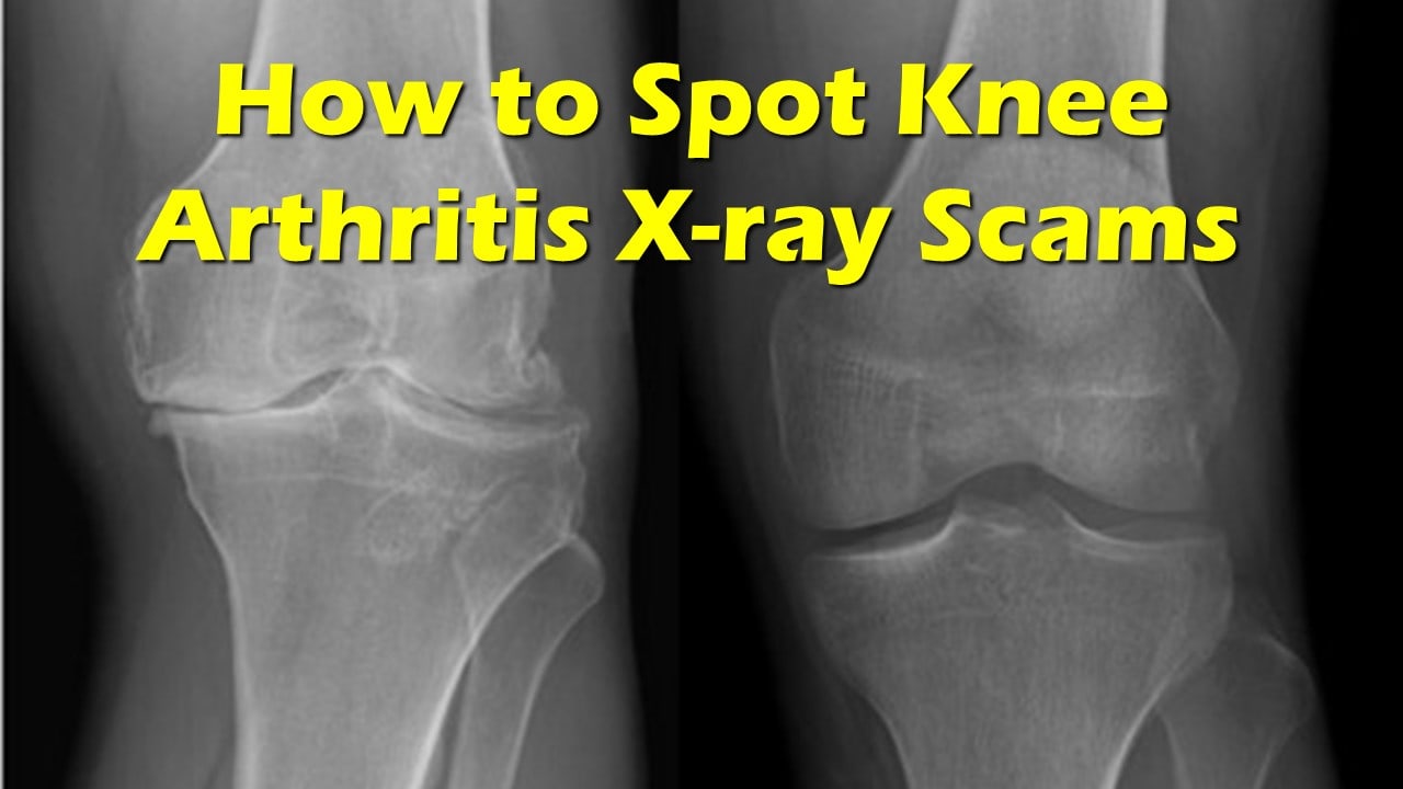 knee arthritis x-rays