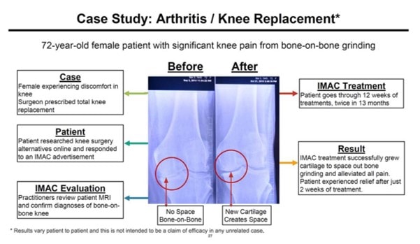 knee xray imac stem cell