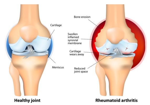 Medical illustration showing a healthy knee and a knee affected by rheumatoid arthritis