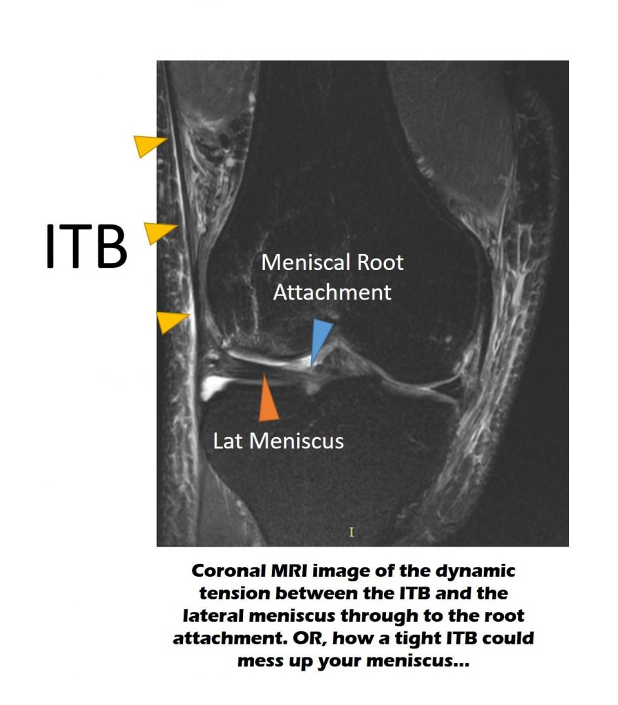 is the itb connected to the lateral meniscus