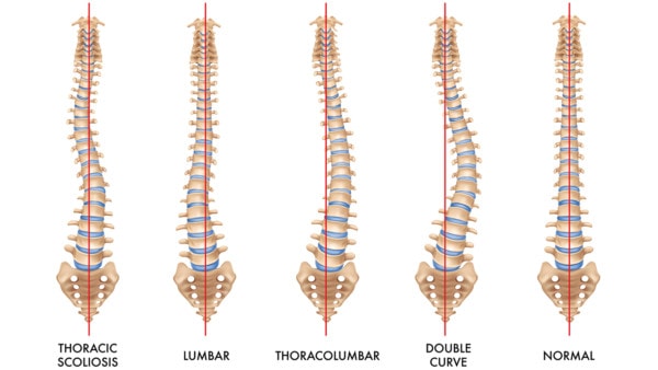 Medical illustration showing a healthy spine and spines affected by four different types of scoliosis