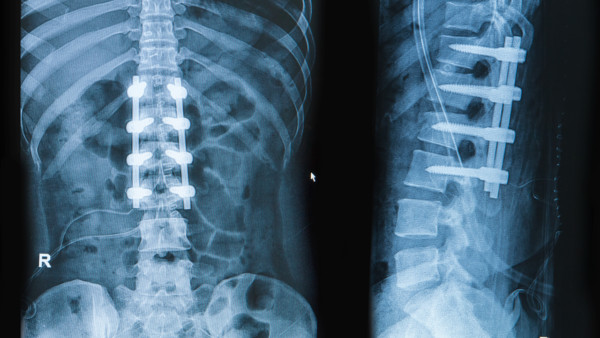 Two X-rays showing the results of spinal fusion surgeries