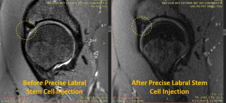 Before and After MRI of patient with torn hip labrum healed with stem cells