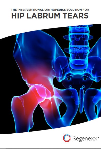 The Interventional Orthopedics Solution For Hip Labrum Tears