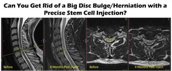 Series of MRIs showing spinal discs before and after stem cell injections with the text overlay: Can You Get Rid of a Big Disc Bulge/Herniation with a Precise Stem Cell Injection