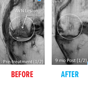 First Example of MRI of Knee AVN