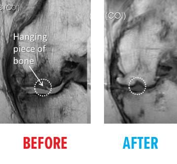 Second Example of MRI of Knee AVN