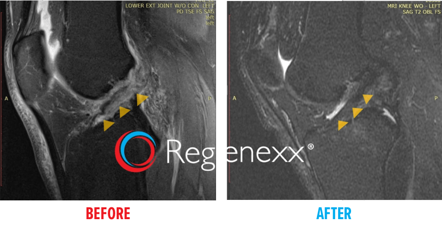 First Example of MRI of Knee ACL Tear