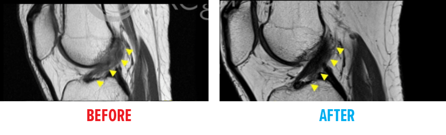 Knee MRI ACL Tear Before & After