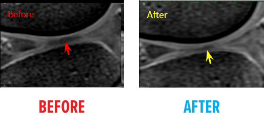 First Example of MRI of Knee Osteochrondal Defect