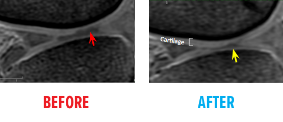 Second Example of MRI of Knee Osteochrondal Defect